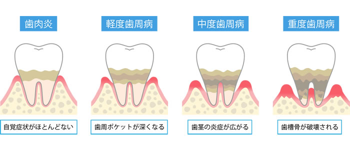 健康な歯茎の場合、歯と歯茎の溝は２〜３mmになりますが、軽度の歯周病では歯周ポケットは４〜５mm、中等度で５～６mm、重度ではそれ以上