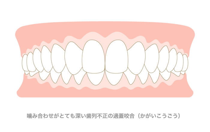 噛み合わせがとても深い歯列不正の過蓋咬合（かがいこうごう）