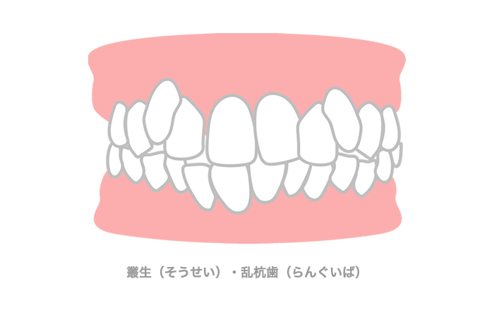 叢生（そうせい）・乱杭歯（らんくいば）