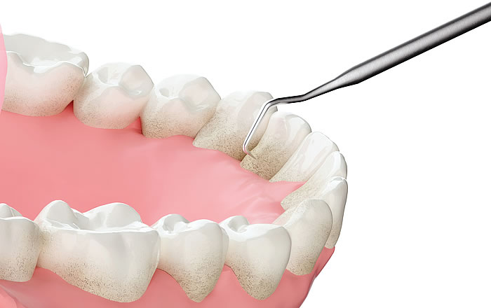 歯のメンテナンスの内容：歯垢や歯石の除去