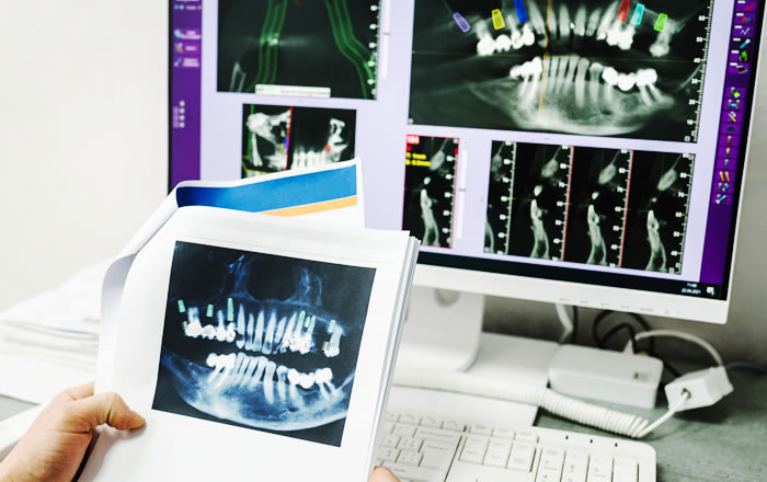 インプラントのメンテナンスで確認すること：レントゲン撮影