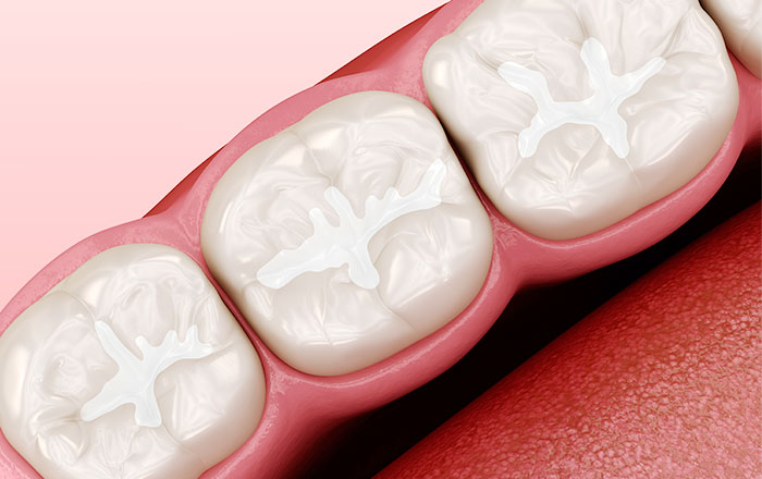 子どもの奥歯の虫歯はシーラントで予防！効果や注意点を解説