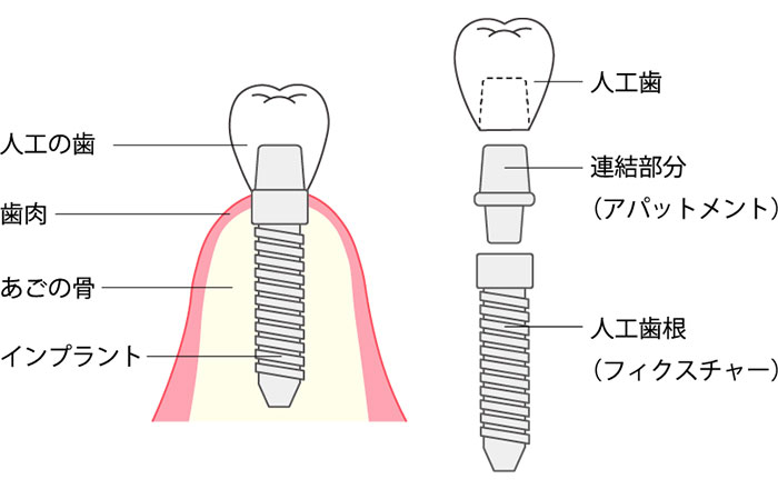 そもそもインプラント治療とは？