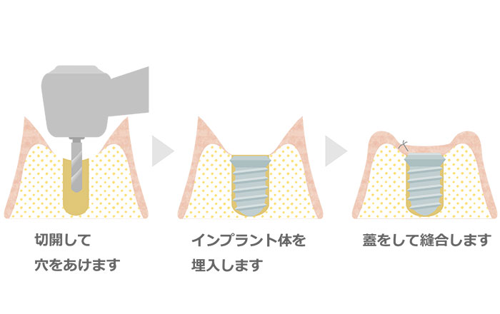 インプラント治療の流れ：５．インプラント一次手術
