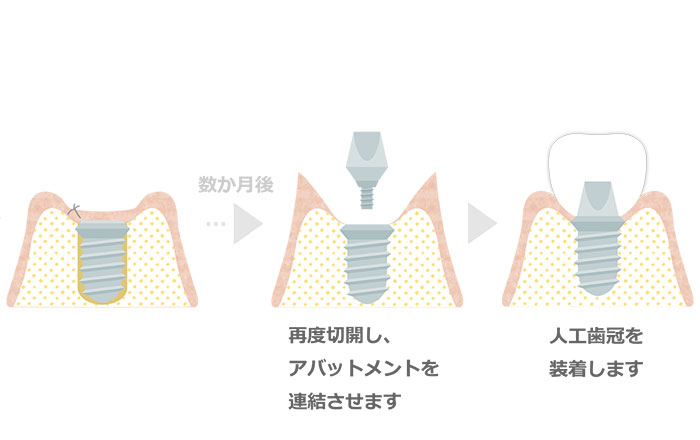 インプラント治療の流れ：6．インプラント二次手術