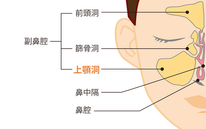 上顎洞迷入