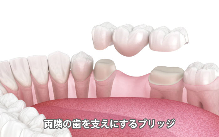 ブリッジの例
