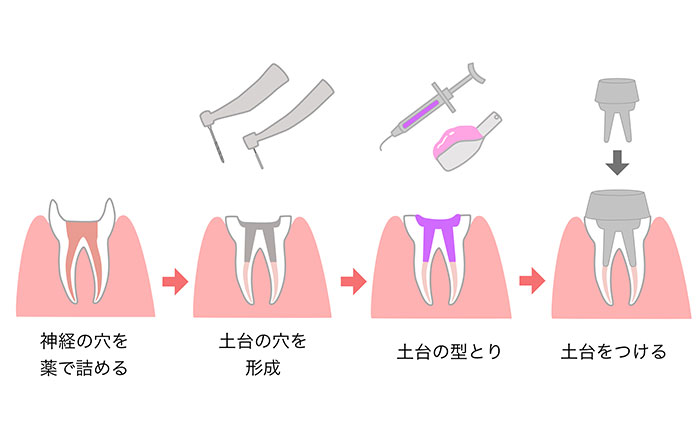 根管治療の流れ：土台（コア）と被せ物（クラウン）の装着