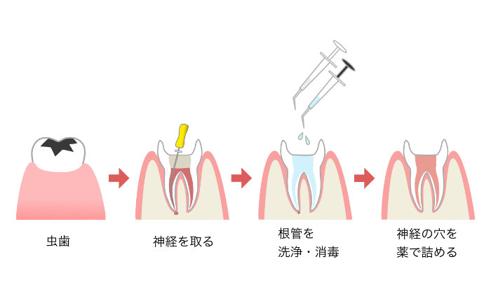 そもそも歯の根の治療（根管治療）とは？