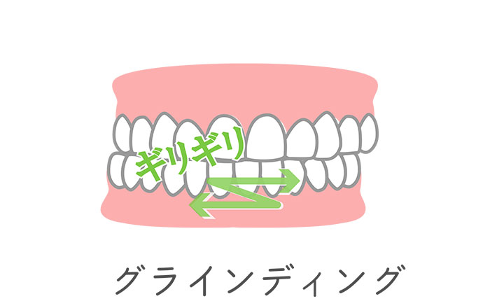 グライディング（歯ぎしり）