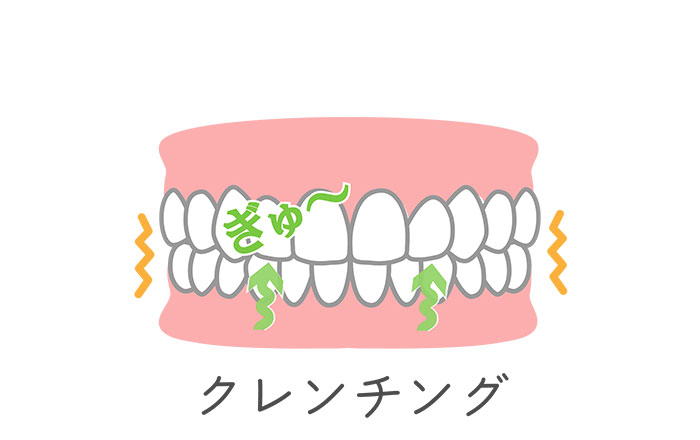 クレンチング（噛みしめ・食いしばり）