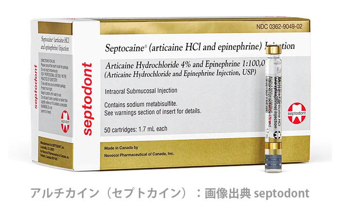 アルチカインってどんな麻酔？