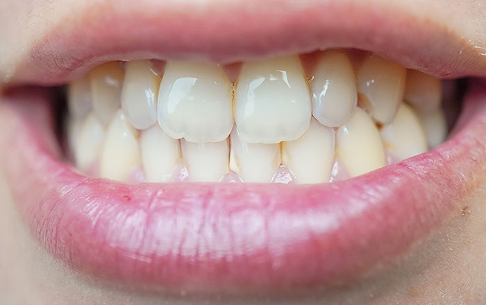 歯ブラシだけでは落とせない汚れとは？