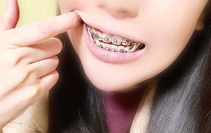 ワイヤー矯正は軽度から重度の歯並びまで、幅広い症例に対応できるのに対し、マウスピース矯正は適応となる症例が限られます。