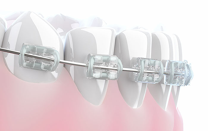 ワイヤー（ブラケット）矯正の特徴とは？