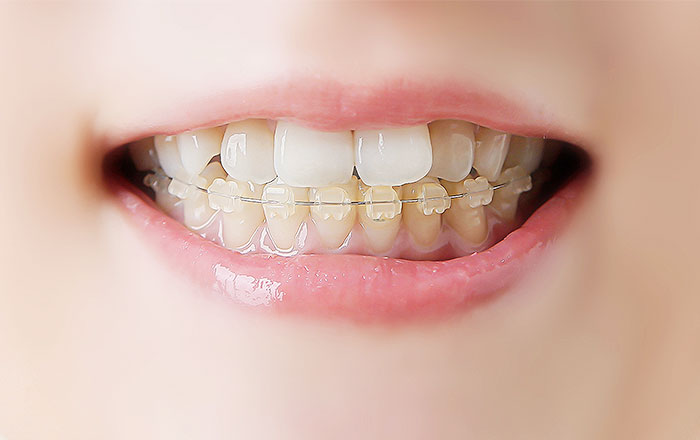 ワイヤー矯正のメリット