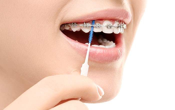 ワイヤーやブラケット周囲に食べ物が詰まりやすいため、歯磨きに工夫が必要
