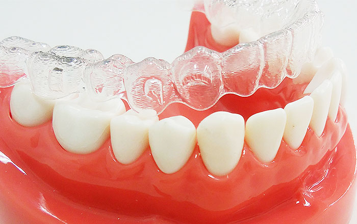 マウスピース矯正の特徴とは？