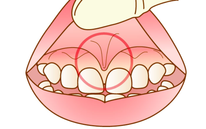 乳歯の磨き方のコツ：上唇小帯に注意する