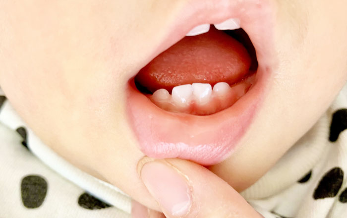 注意が必要な歯の形～ 癒着歯、癒合歯