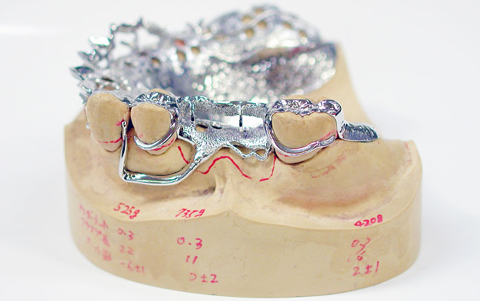 歯科医院での入れ歯製作の流れ