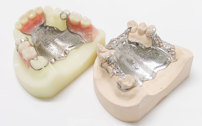 金属床義歯（メタルデンチャー）