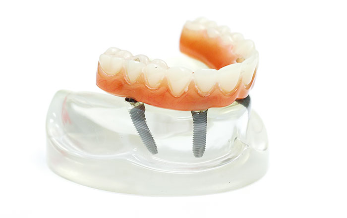 インプラントオーバーデンチャー
