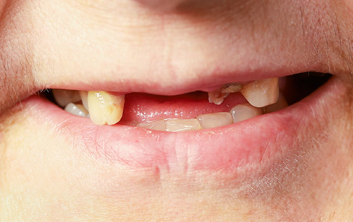 自分に合った入れ歯を選ぶ5つのポイント：① 残っている歯の本数と状態を確認する