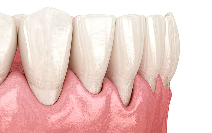 加齢とともに変わるお口の環境：歯茎の変化（歯肉退縮）