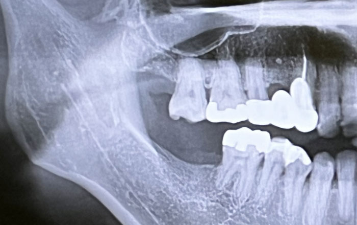加齢とともに変わるお口の環境：歯槽骨の減少
