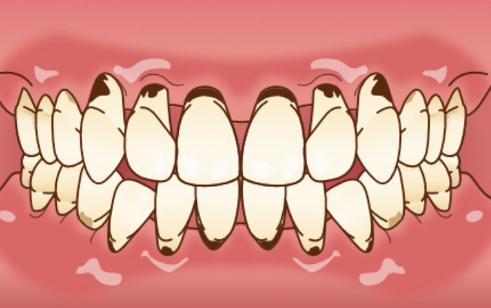 根面う蝕の増加