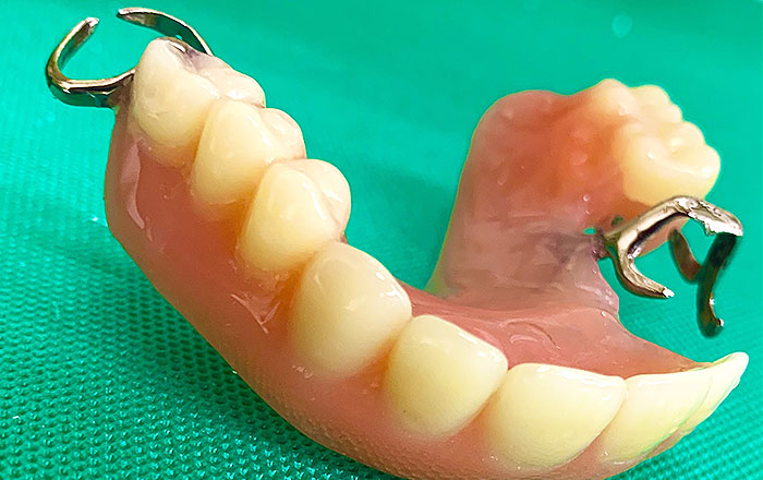 入れ歯にトラブルが起きる5つの原因:①歯茎や骨の形が変化してフィット感がなくなる