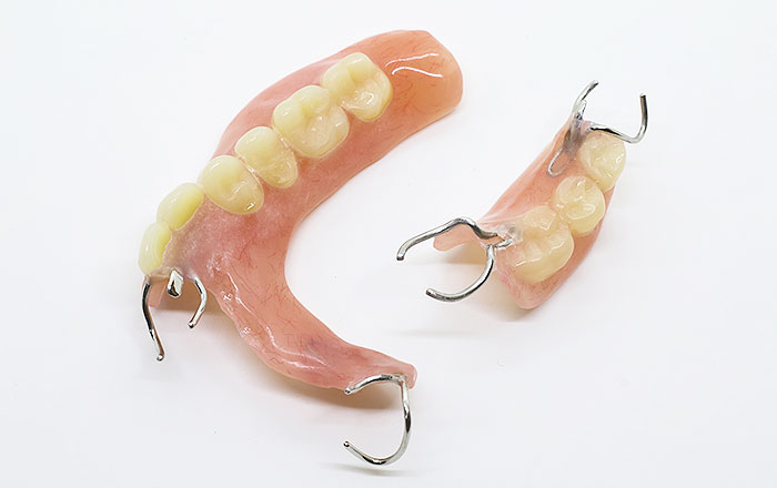 入れ歯にトラブルが起きる5つの原因:④部分入れ歯のバネ(クラスプ)の劣化