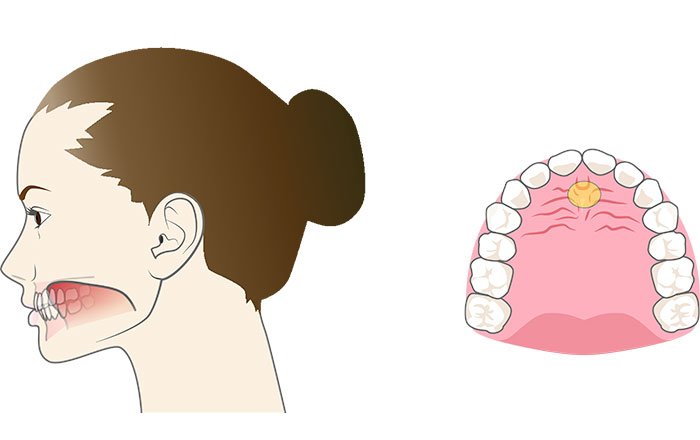 歯並びを守る正しい対策法：舌の正しい位置を覚える