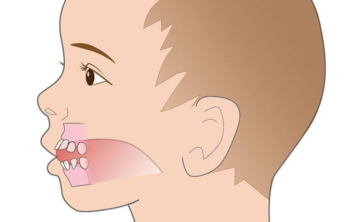 歯並びに悪影響を与える習慣：② 舌突出癖（舌癖）