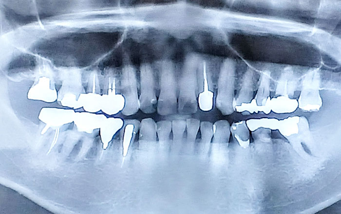 エクストリュージョンのデメリット：歯根が短くなる