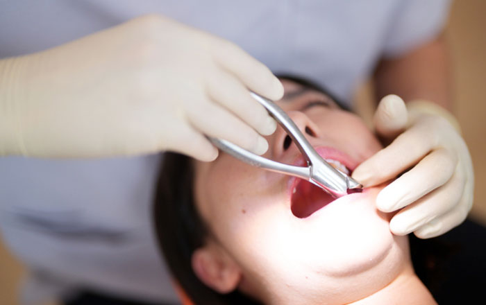 それでも抜歯が適切なケースもあります