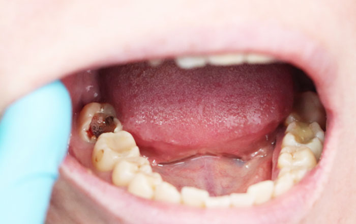 虫歯で「抜歯が必要」と言われる歯はどんな状態？