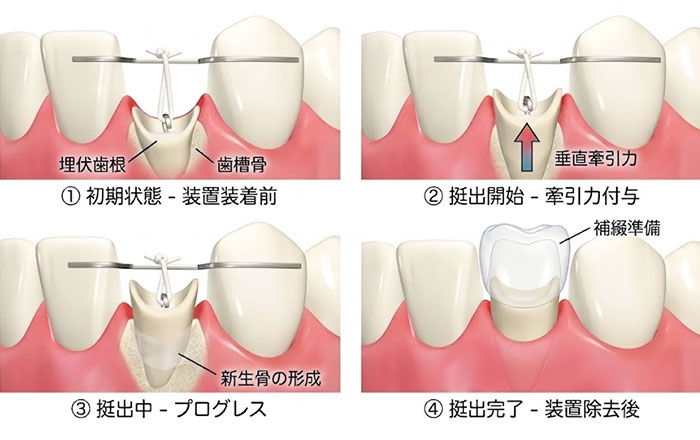 エクストリュージョンとは、歯茎の下に埋もれている歯根を、矯正の力を使ってゆっくりと引き上げる治療法であり、矯正的挺出法といいます。