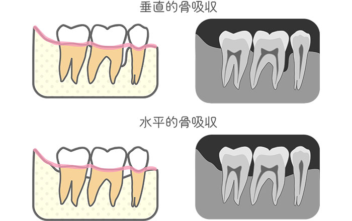 歯周再生治療が難しいケース