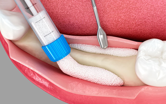 GBR（Guided Bone Regeneration：骨再生誘導法）
