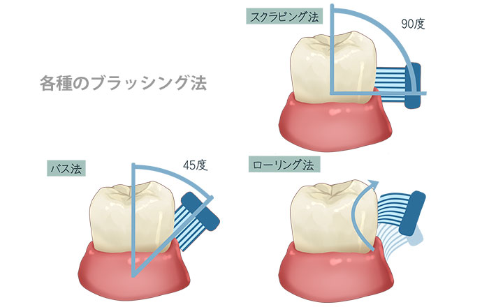 手磨き用歯ブラシのデメリット:正しい磨き方の習得と継続が難しい
